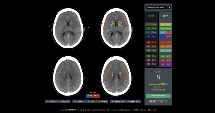 aspect-score-stroke-neuroimaging-device-rapid-aspects